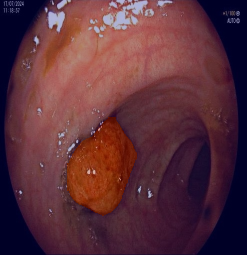 Polip Segmentasyonu